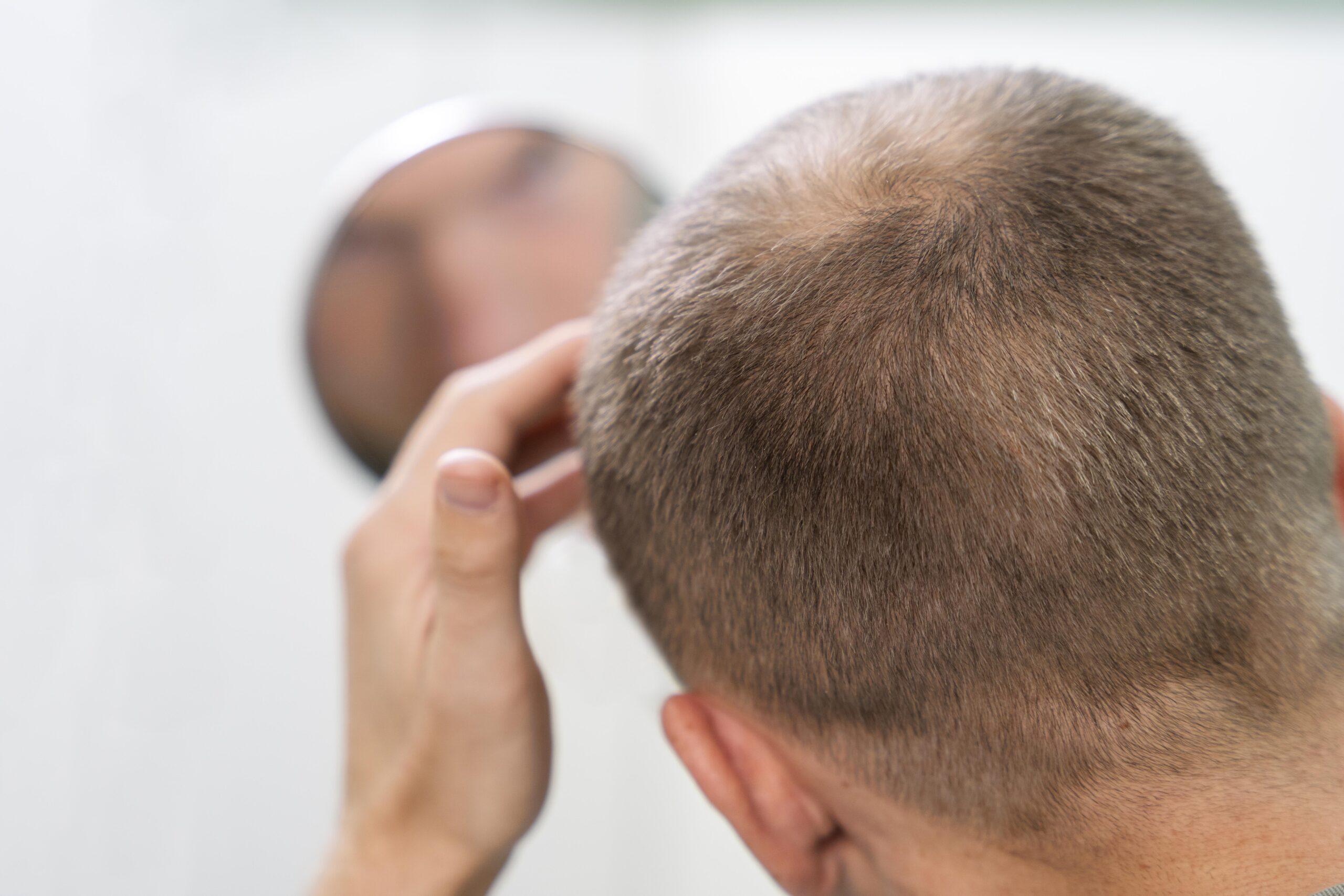 Alopecia Understanding Hair Loss and Treatment