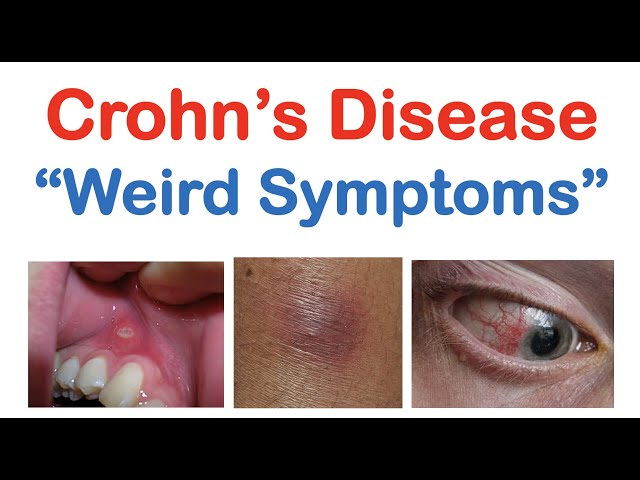 crohn's disease dermatology